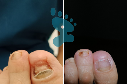 Reconstrucción con la uña de gel podológico.