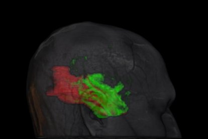 Nuevas herramientas para comprender el alzhéimer: comparación entre SPM y SAM, desarrollado por Juan Manuel Górriz, que permite identificar patrones conjuntos de alteraciones cerebrales.
