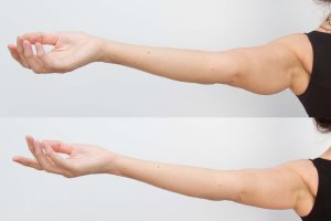 Antes y después del tratamiento con HIFU.