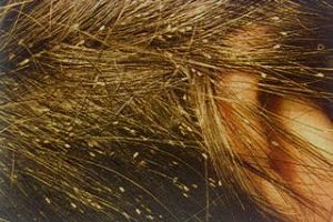 Cabello infectado por piojos. Fuente: Internet.