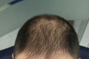 Antes de implantar pelo en la zona afectada.