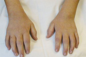 Foto de la manos de un niño con artritis reumatoide.