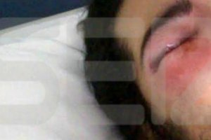 Imagen del ojo del joven tras recibir el golpe.