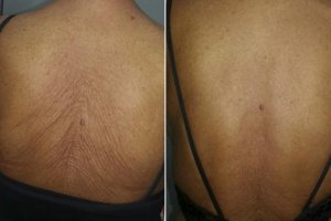 Antes y después de la espalda de un paciente tras la aplicación de una única sesión láser para reducir la flacidez.