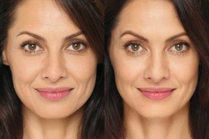 Lifting líquido, devuelve la belleza a tu rostro en sólo 3 sesiones.