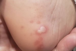 Aunque el estudio ha observado esta relación, recuerda que otros factores pueden provocar estas manifestaciones cutáneas como los fármacos.