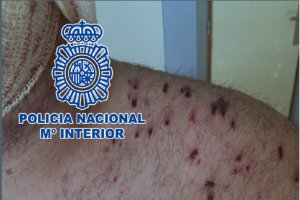 Imagen de algunas de las heridas de perdigón en el cuerpo de la víctima.