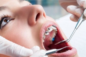 El Supremo ha dictaminado que los pacientes tienen derecho a elegir protésico dental.
