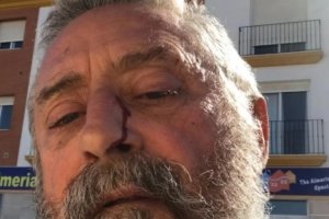 El alcalde mostrando la herida producida por el golpe que recibió.