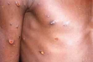 Las erupciones suelen presentarse junto con el inicio de fiebre.