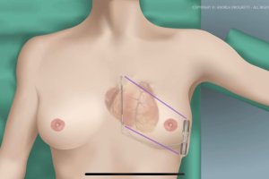 Con esta práctica se elimina las complicaciones vasculares e intracardiacas con la misma efectividad y longevidad que los desfibriladores convencio