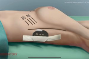 Nueva técnica implante S-ICD.