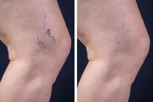 Pierna con varices