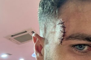 Así quedó el rostro de Embarba con varios puntos en su rostro. 