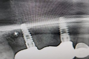 Implantología dental.