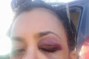 Rostro de I.R. dos días después de haber sufrido la presunta agresión.