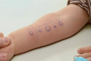 Imagen de una prueba de alergia realizada a un niño