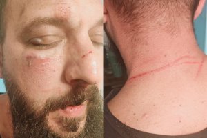 Resultado de las agresiones recibidas por el agente de la Guardia Civil en Roquetas de Mar.