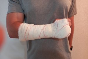 Imagen de la lesión sufrida por un agente de la Guardia Civil en Roquetas de Mar.