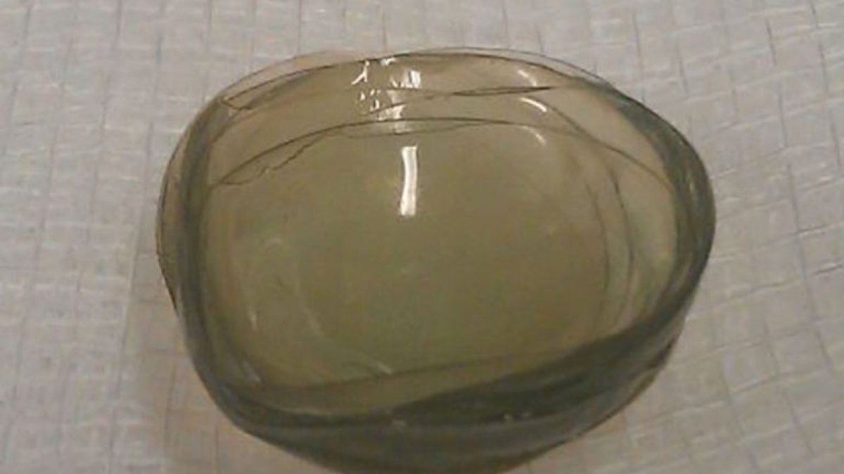 Las primeras 17 lentes de contacto encontradas. / British Medical Journal
