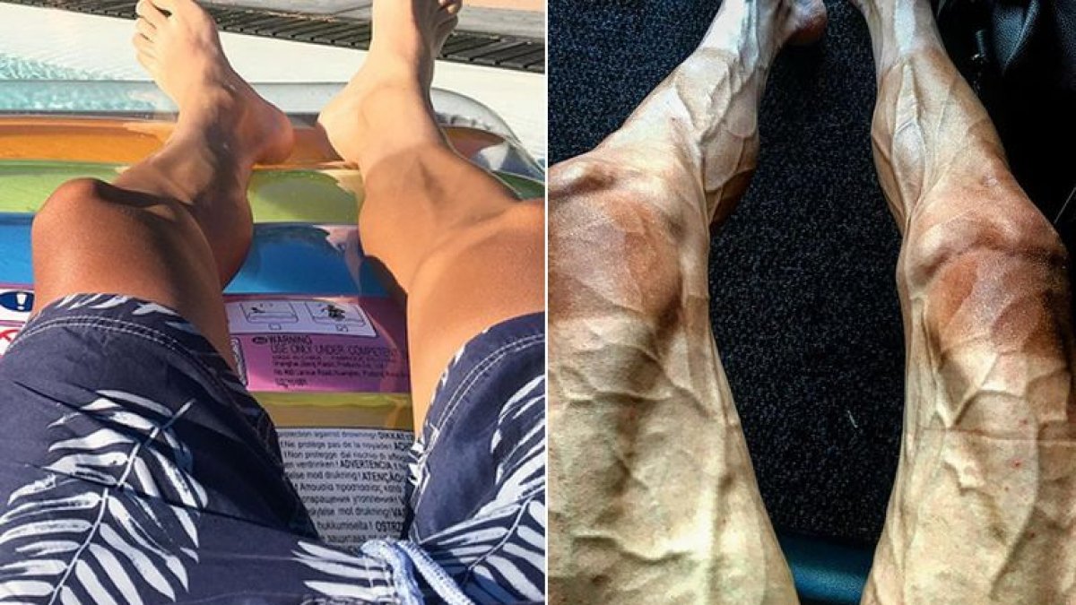 El antes y el después de las piernas del ciclista Pawel Poljanski.