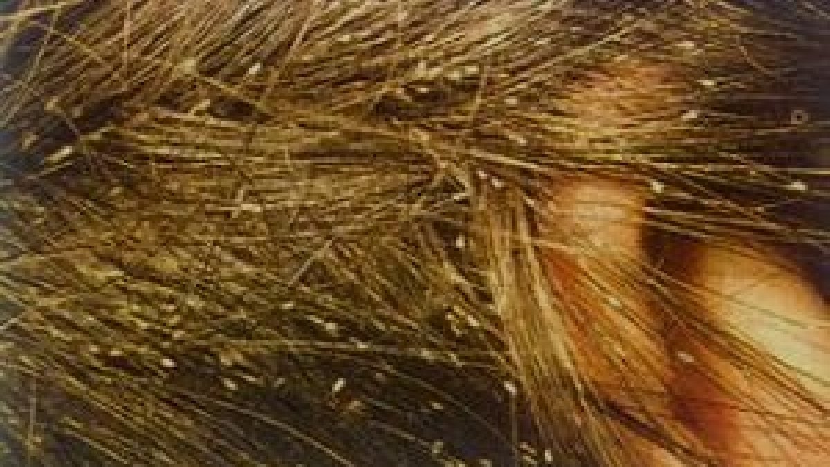 Cabello infectado por piojos. Fuente: Internet.