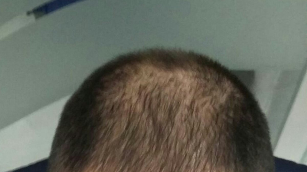 Antes de implantar pelo en la zona afectada.