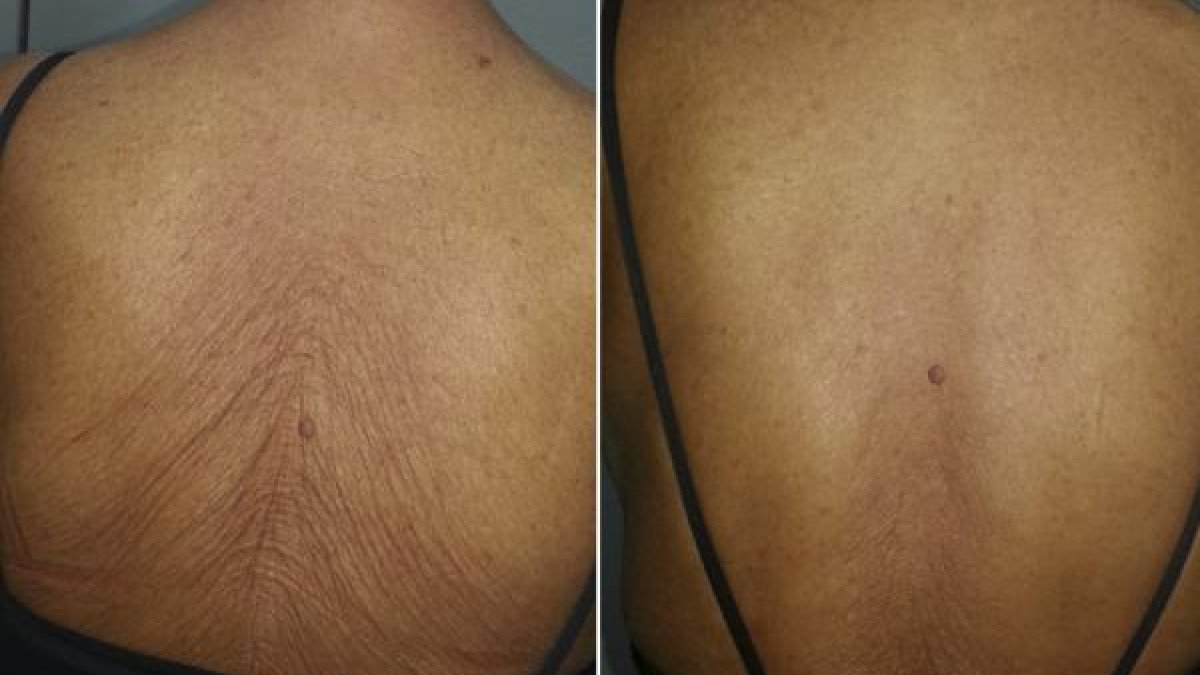 Antes y después de la espalda de un paciente tras la aplicación de una única sesión láser para reducir la flacidez.