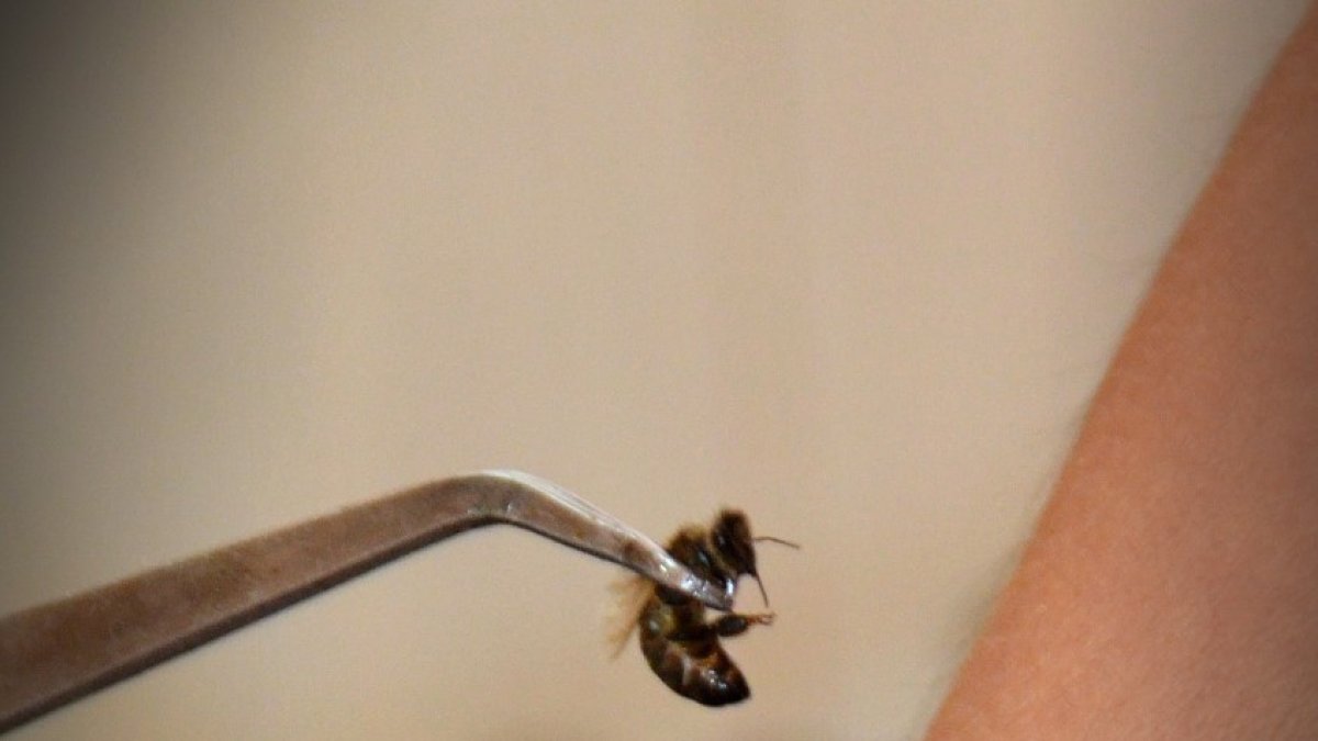 Sergio Guerrero en su centro de apiterapia y aplicando el veneno de abeja a través de una picadura controlada durante apenas dos segundos.