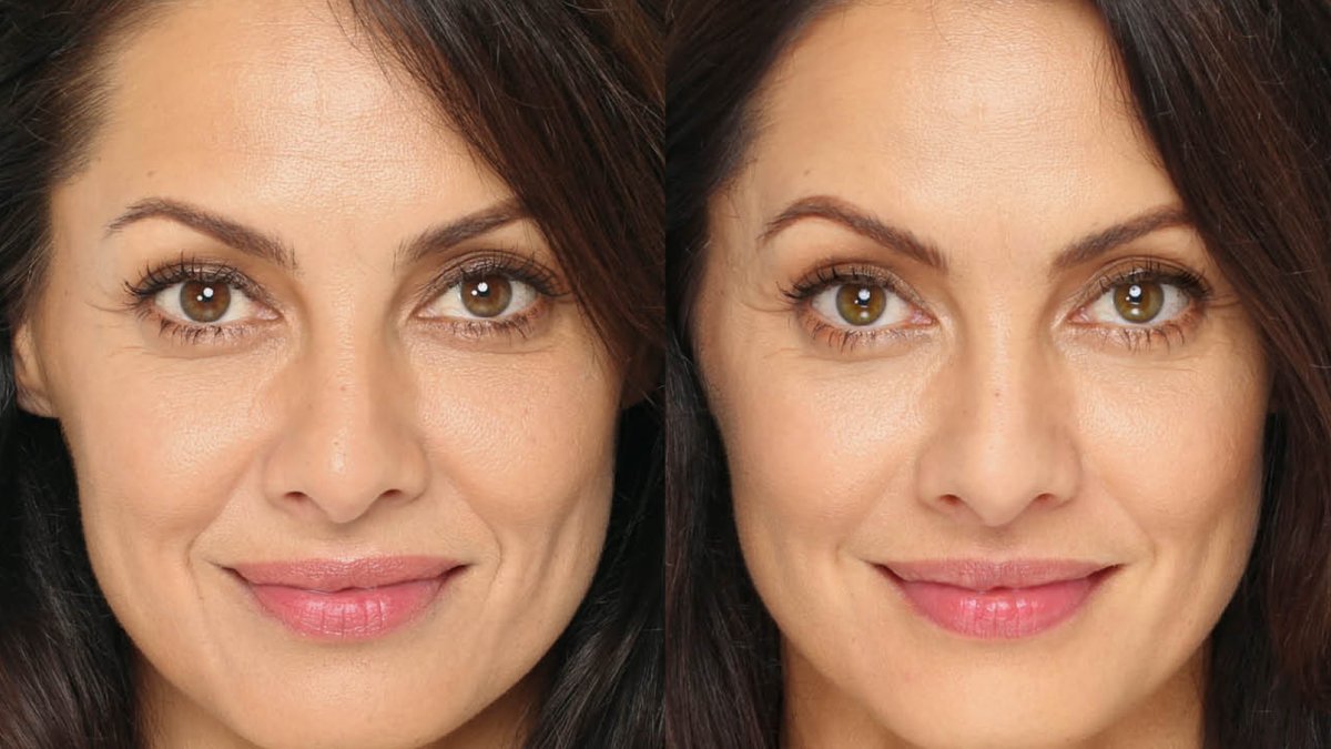 Lifting líquido, devuelve la belleza a tu rostro en sólo 3 sesiones.