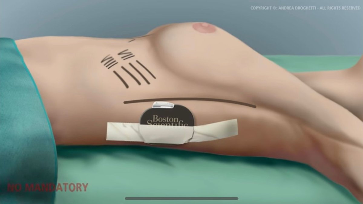 Nueva técnica implante S-ICD.