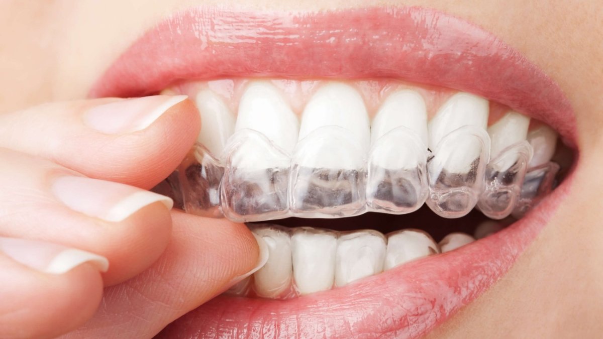 Férulas cómodas y transparentes.