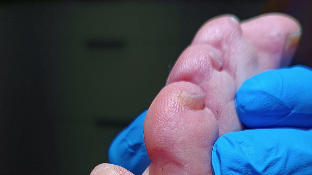 Ojo de gallo u ojo de pollo.