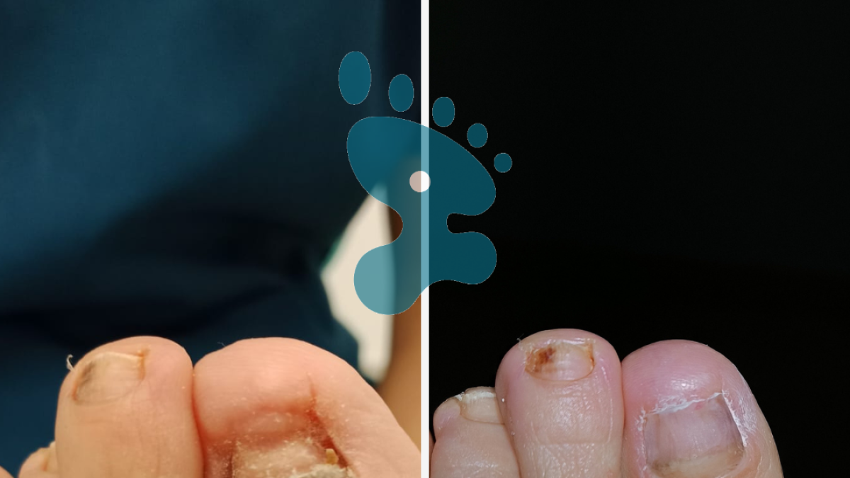 Reconstrucción con la uña de gel podológico.