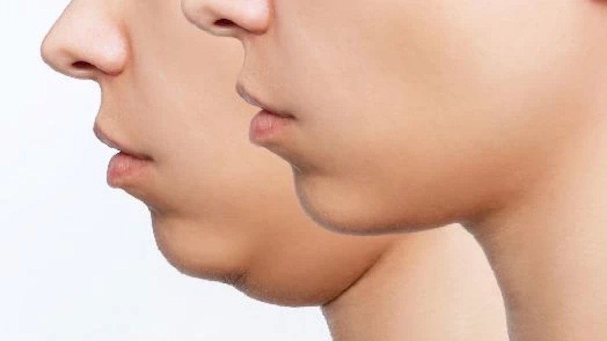 Mewing, la técnica de las famosas para eliminar papada