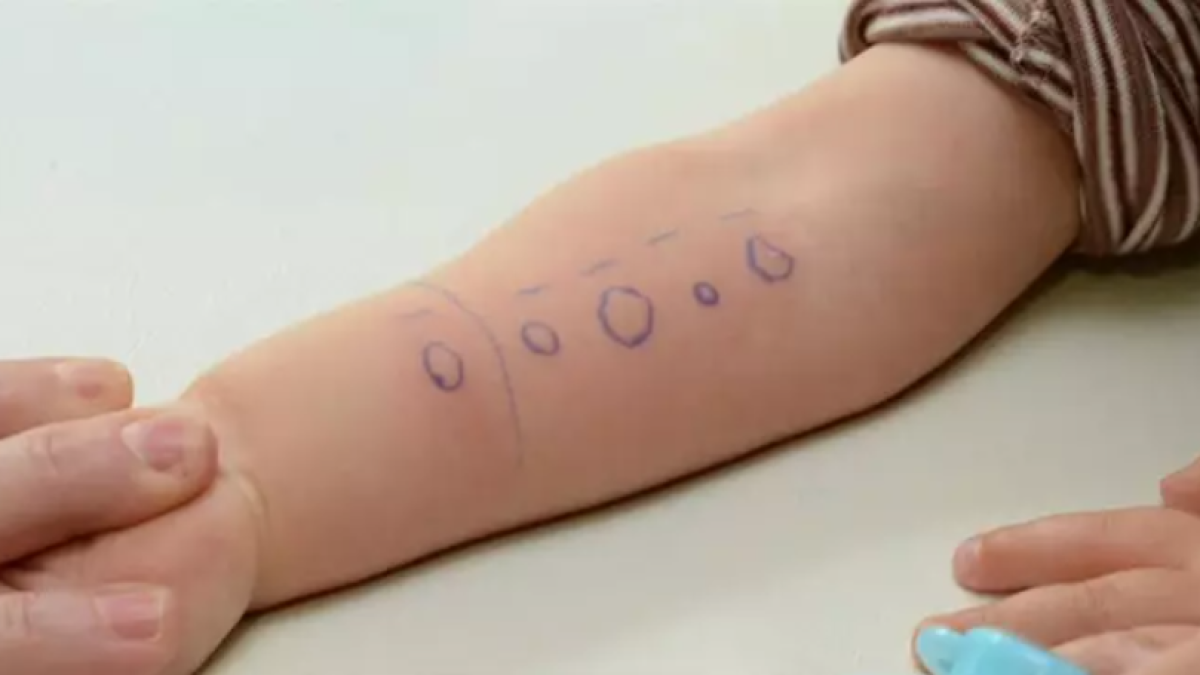 Imagen de una prueba de alergia realizada a un niño