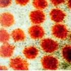 Hepatitis A: Foto: ECDC-Archivo