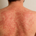 Un paciente con pitiriasis versicolor.