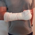 Imagen de la lesión sufrida por un agente de la Guardia Civil en Roquetas de Mar.