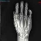 En España, la prueba más habitual para determinar la minoría de edad de los menas es una radiografía de la mano y la muñeca.