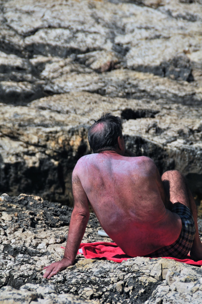 Un hombre toma el sol con la piel enrojecida.
